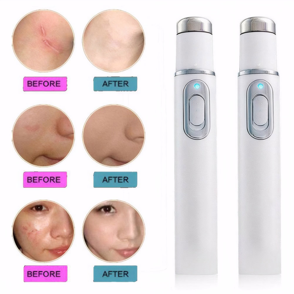 Blaulicht-Therapie, Akne-Stift – Acne Light Therapy Pen Bewertung und Preis